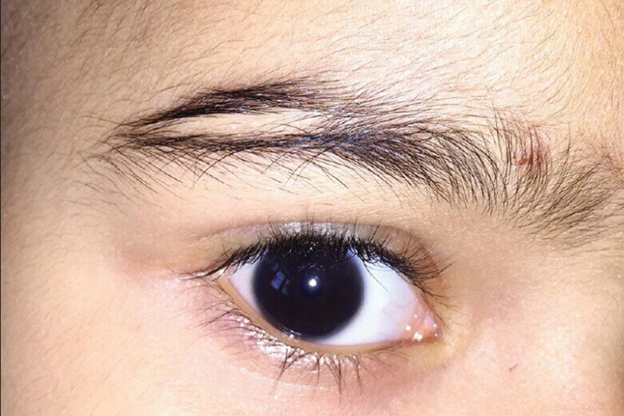 Mức độ tổn thương sâu có thể khiến lông mày không thể mọc lại ở vùng da bi bị sẹo