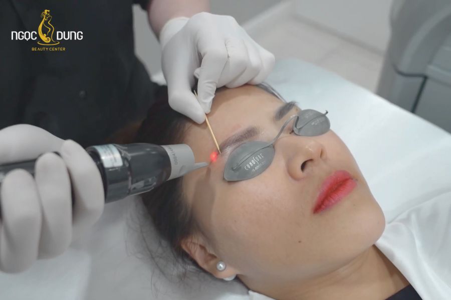 TMV Ngọc Dung là địa chỉ uy tín trong việc xóa xăm chân mày bằng laser