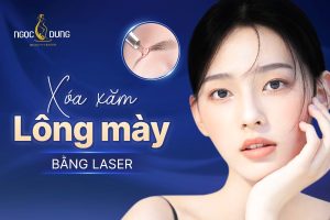 Xóa xăm lông mày bằng laser