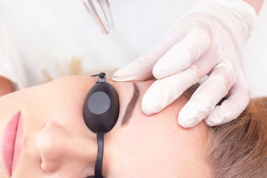 Xóa xăm lông mày bằng laser được đánh giá cao bởi tính hiệu quả, an toàn và ít gây tổn thương