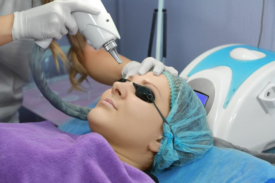 xoa xam mi bang laser