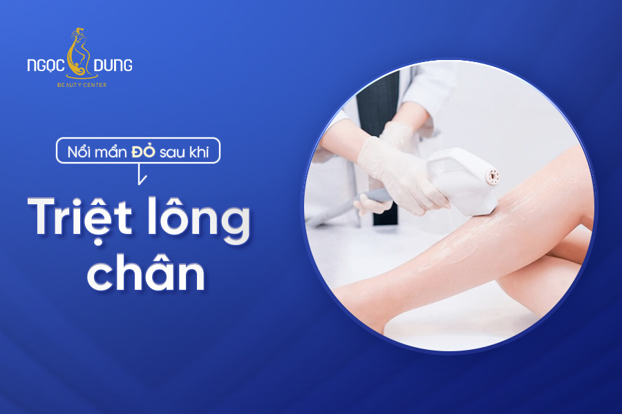 nổi mẫn đỏ sau khi triệt lông chân