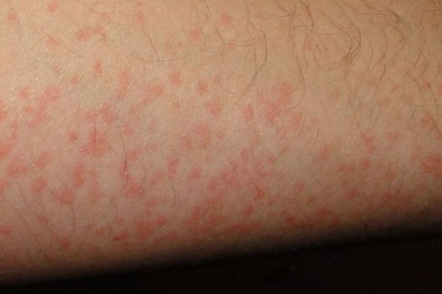 Cách xử lý nổi mẩn đỏ sau khi triệt lông chân hiệu quả 2025 2 Trình trạng nổi mẩn đỏ sau khi triệt lông chân thường tự khỏi sau 1-2 ngày