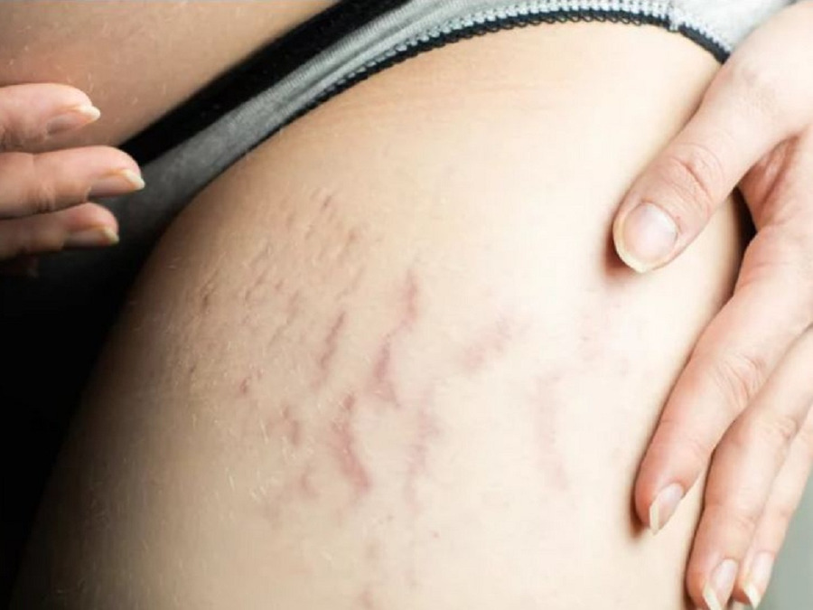 Di truyền là yếu tố dẫn đến tình trạng rạn da cao hơn