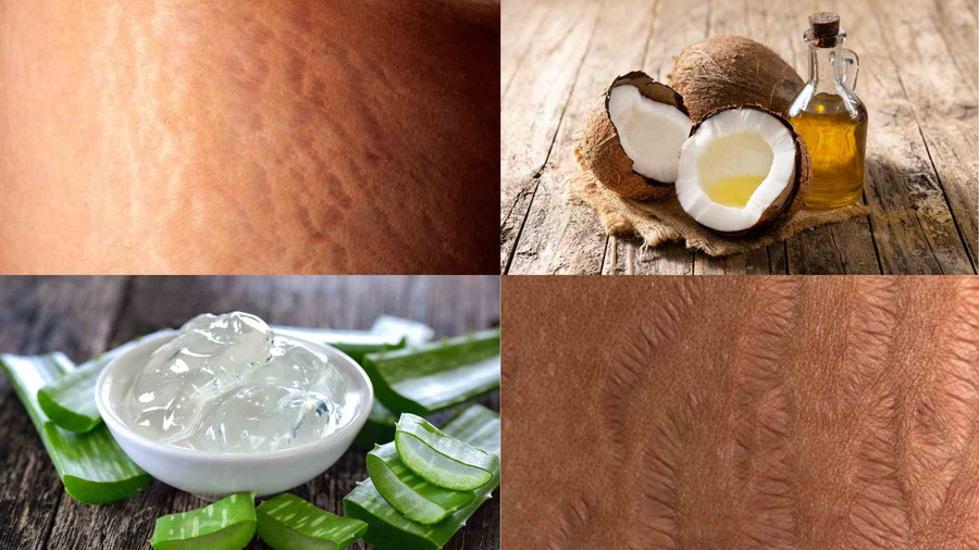 Sử dụng các nguyên liệu tự nhiên trị rạn da