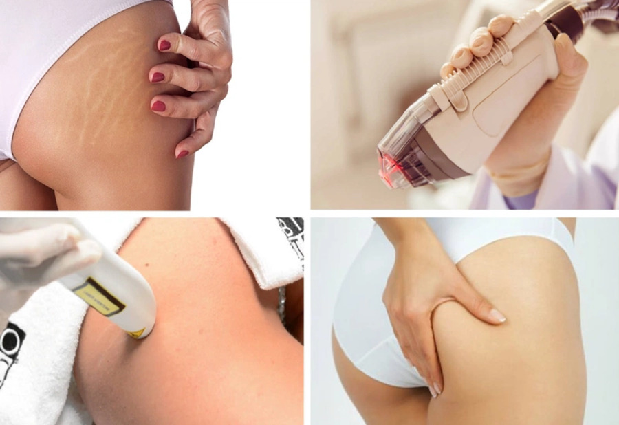 Sử dụng công nghệ hiện đại trị rạn da mông