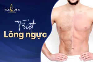 Triệt lông ngực