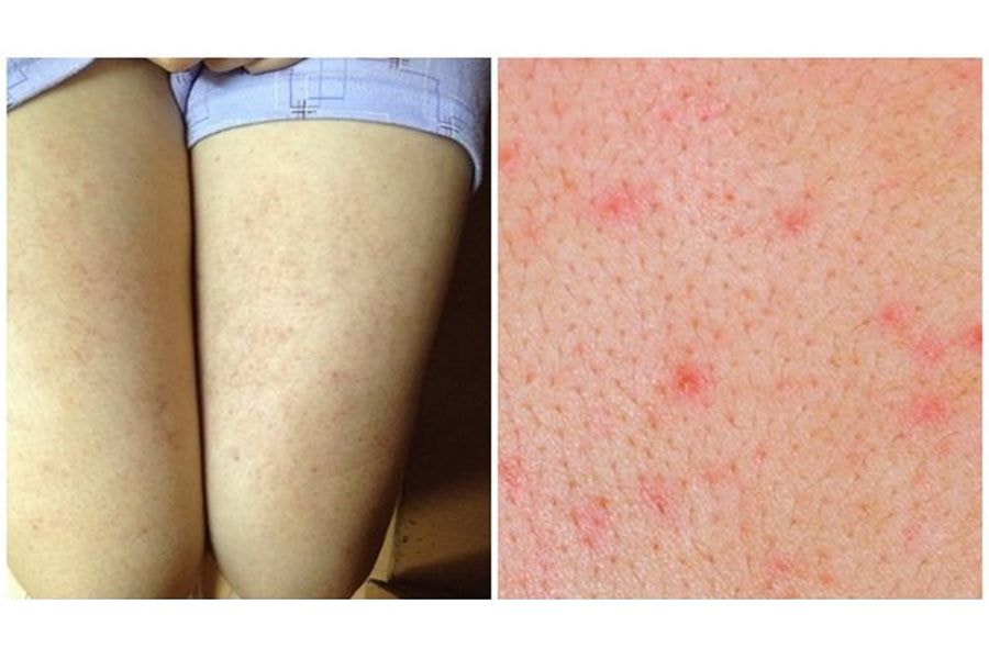 Cách xử lý nổi mẩn đỏ sau khi triệt lông chân hiệu quả 2025 3 Viêm nang lông cũng là một rủi ro thường gặp sau khi triệt lông chân