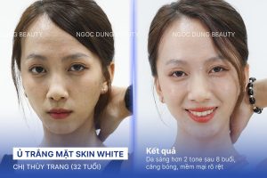 Chị Thuỳ Trang (40 tuổi) - Ủ Trắng Mặt Skin White