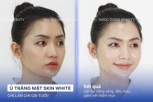 Chị Lan Chi (29 tuổi) - Ủ Trắng Mặt Skin White