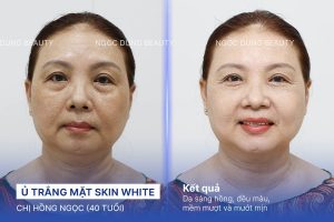 Chị Hồng Ngọc (40 tuổi) - Ủ Trắng Mặt Skin White