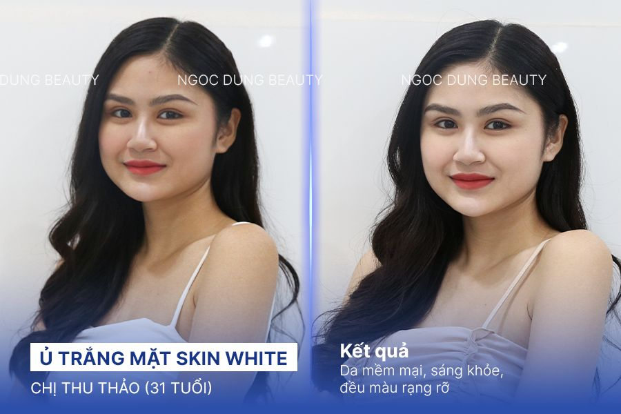 Ủ trắng mặt skin white – 7 buổi – Da hồng hào trẻ trung