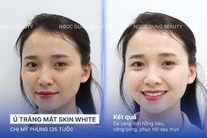 Chị Mỹ Phụng (35 tuổi) - Ủ Trắng Mặt Skin White