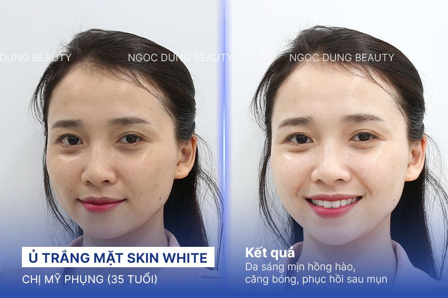 Chị Mỹ Phụng (35 tuổi) - Ủ Trắng Mặt Skin White