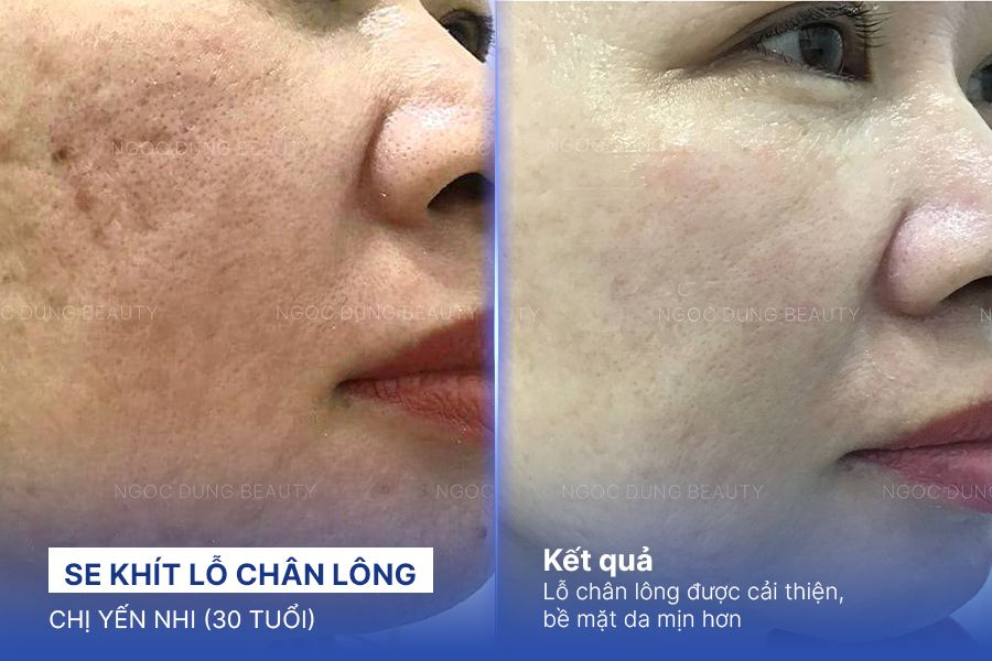 Se khít lỗ chân lông – 6 Buổi – Da láng mịn rạng rỡ