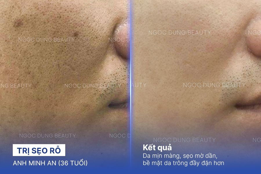 Trị sẹo rỗ – 5 Liệu trình – Sẹo mờ và da mịn màng hơn