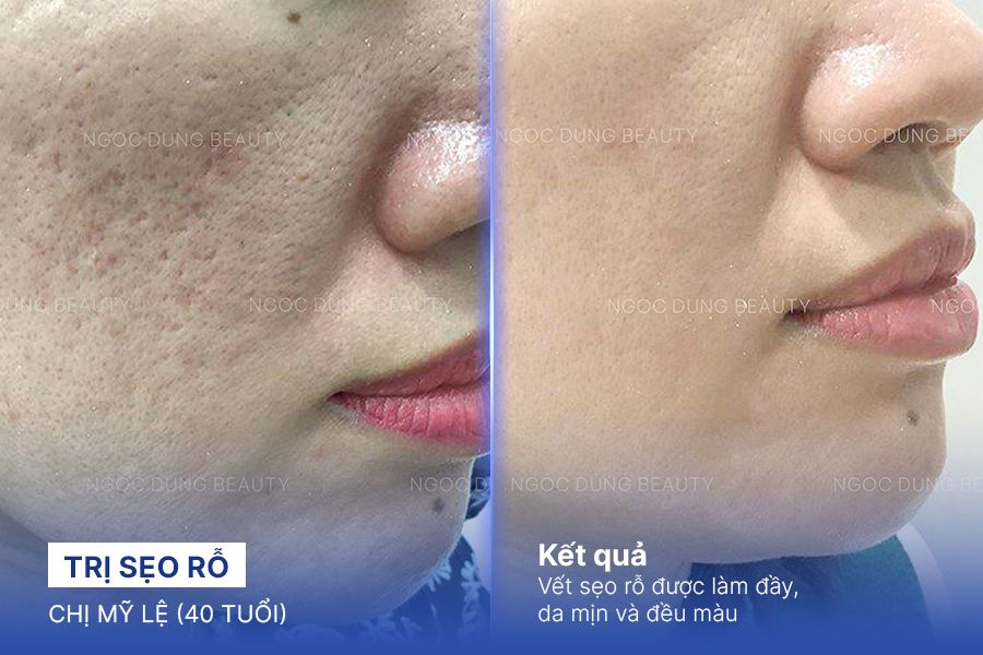 Trị sẹo rỗ – 8 Liệu trình – Làm đều phần da sẹo rỗ