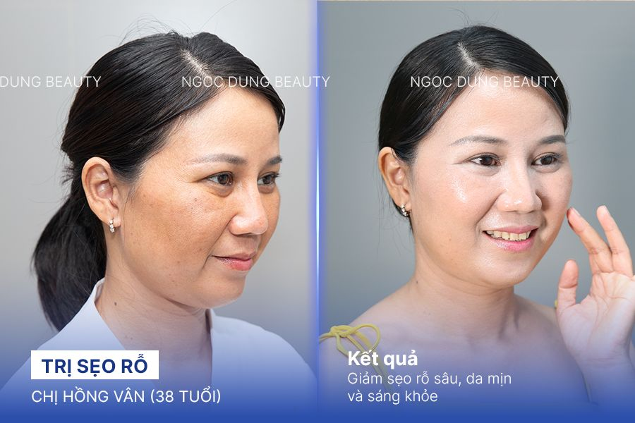 Trị sẹo rỗ – 9 Liệu trình – Làm mờ sẹo rỗ chân sâu