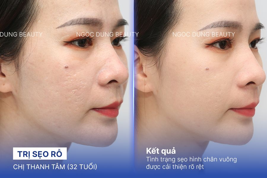 Trị sẹo rỗ – 6 liệu trình – Khắc phục sẹo chân vuông