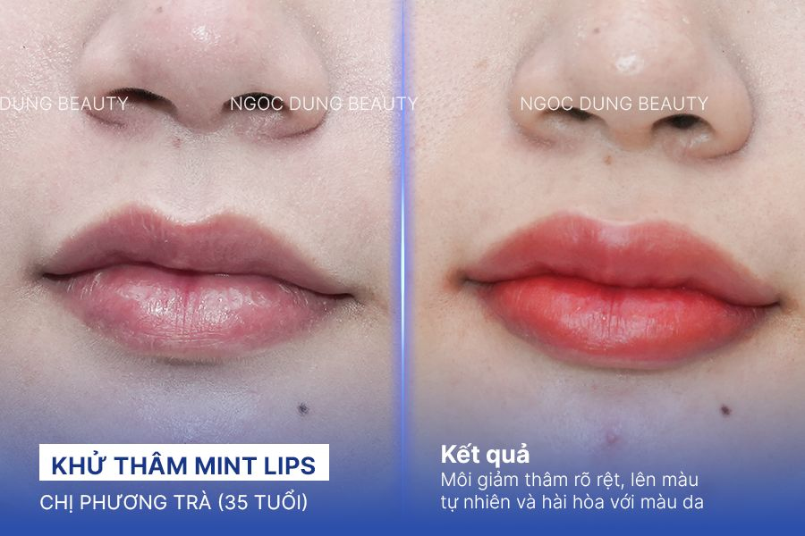 Chị Phương Trà (35 tuổi) - Khử Thâm Mint Lips