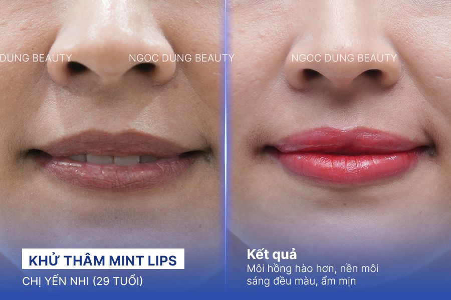 Chị Yến Nhi (29 tuổi) - Khử Thâm Mint Lips