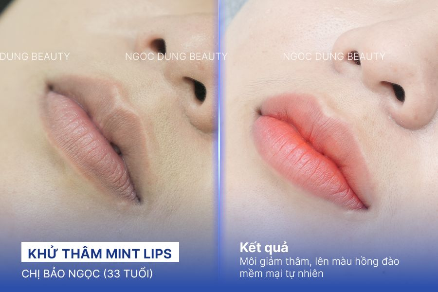 Chị Bảo Ngọc (33 tuổi) - Khử Thâm Mint Lips