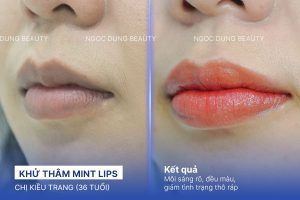 Chị Kiều Trang (36 tuổi) - Khử Thâm Mint Lips