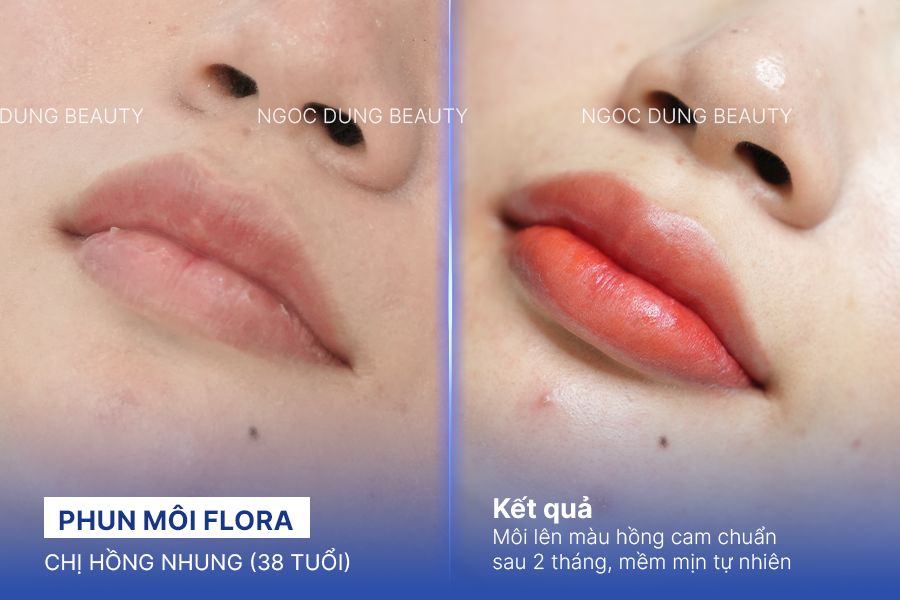 Chị Hồng Nhung (38 tuổi) - Khử Thâm Mint Lips