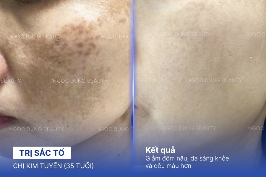 Chị Kim Tuyến (35 tuổi) - Trị Sắc Tố