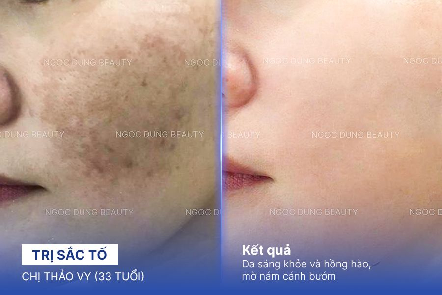 Chị Thảo Vy (33 tuổi) - Trị Sắc Tố