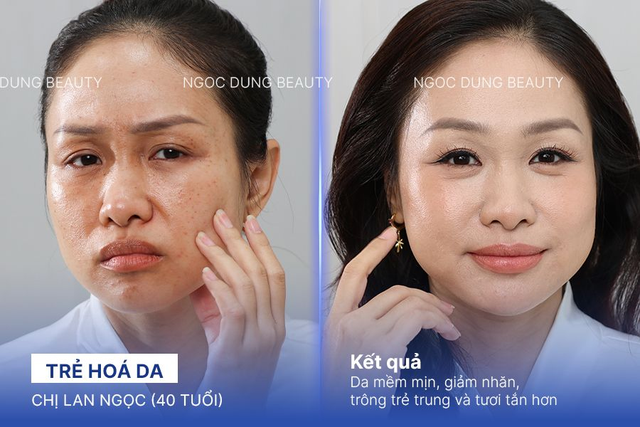 Chị Lan Ngọc Trẻ hoá da
