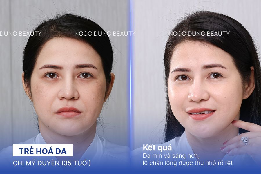 Chị Mỹ Duyên (35 tuổi) - Trẻ Hoá Da