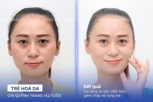 Chị Quỳnh Trang (42 tuổi) - Trẻ Hoá Da