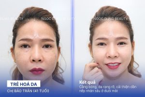 Chị Bảo Trân (41 tuổi) - Trẻ Hoá Da