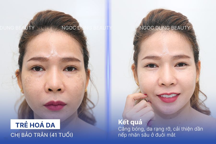 Chị Bảo Trân (41 tuổi) - Trẻ Hoá Da