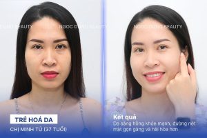 Chị Minh Tú (37 tuổi) - Trẻ Hoá Da