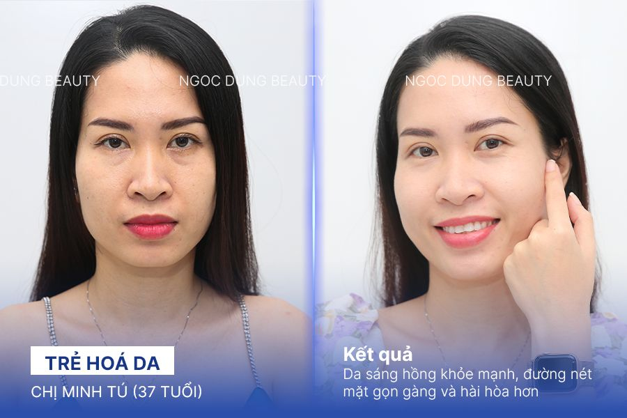 Chị Minh Tú (37 tuổi) - Trẻ Hoá Da