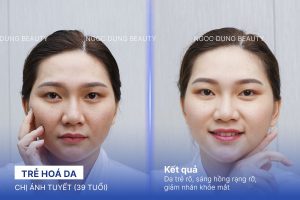 Chị Ánh Tuyết (39 tuổi) - Trẻ Hoá Da