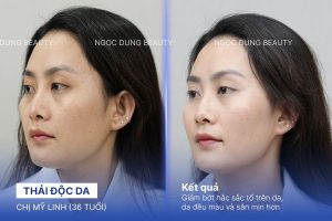 Chị Mỹ Linh (36 tuổi) - Trẻ Hoá Da