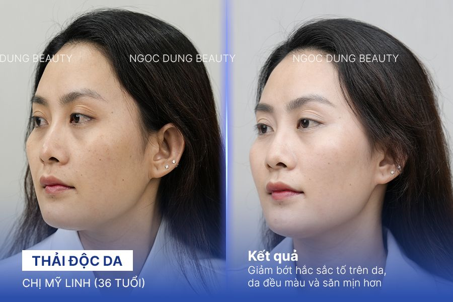 Chị Mỹ Linh (36 tuổi) - Trẻ Hoá Da