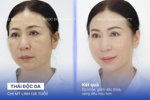 Chị Mỹ Linh (35 tuổi) - Thải Độc Da