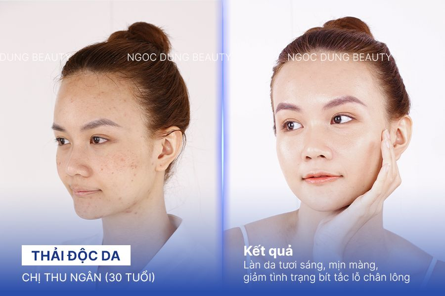 Chị Thu Ngân (30 tuổi) - Thải Độc Da