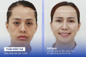 Chị Hoài An (29 tuổi) - Thải Độc Da