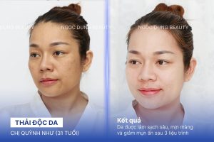 Chị Quỳnh Như (31 tuổi) - Thải Độc Da