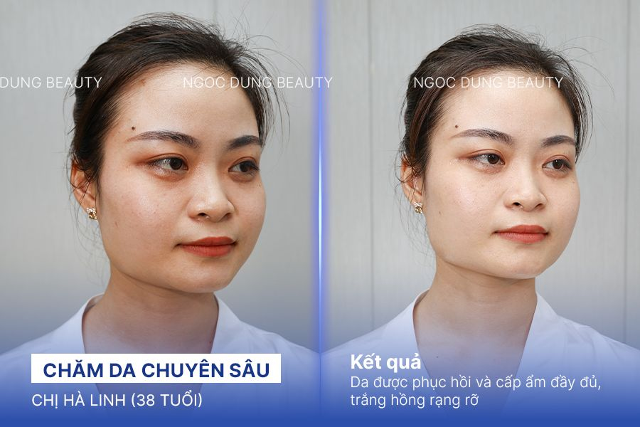 Chăm da chuyên sâu – 4 buổi – Da tươi trẻ mướt mát