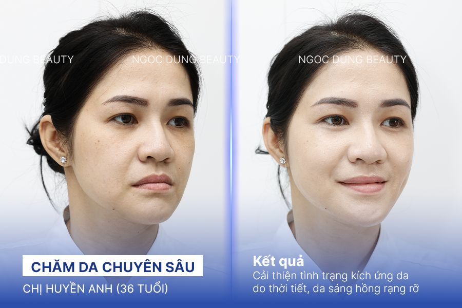 Chăm da chuyên sâu – 5 buổi – Da đã giảm kích ứng