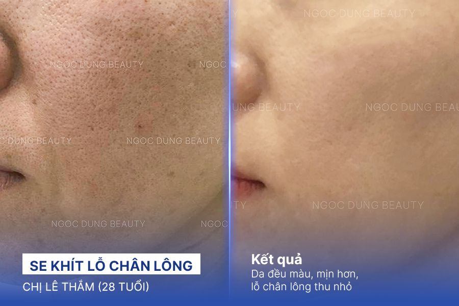 Se khít lỗ chân lông – 10 Buổi – Da mịn màng tươi tắn