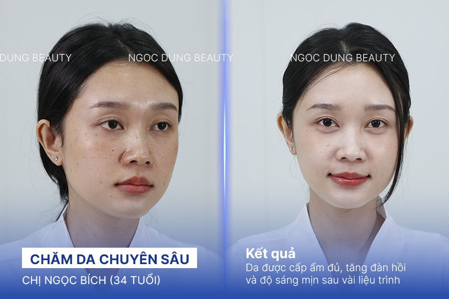 Chăm da chuyên sâu – 4 buổi – Da đàn hồi giảm thâm