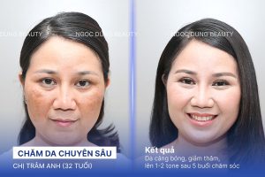 Chị Trâm Anh (32 tuổi) - Chăm Da Chuyên Sâu