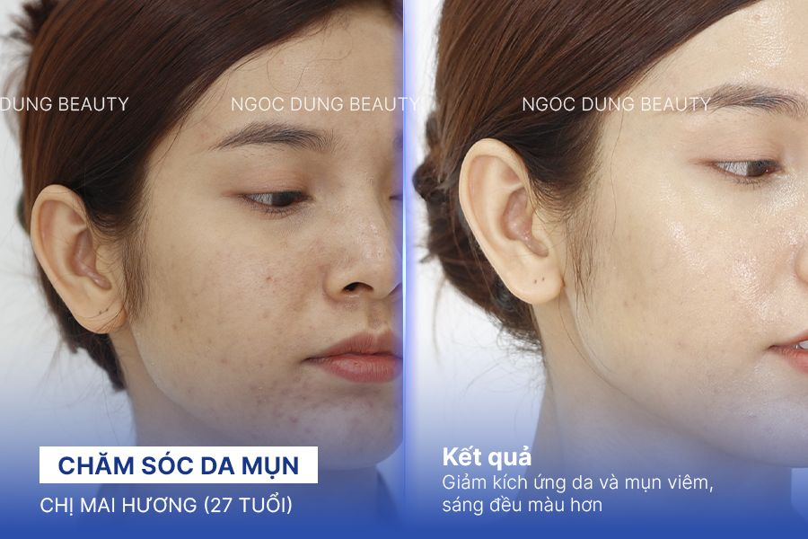 Chăm sóc da mụn – 7 buổi – Da đều màu giảm thâm